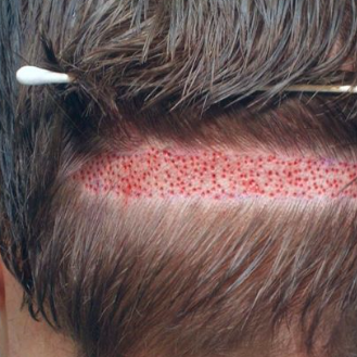 Hairtransplant InPakistan