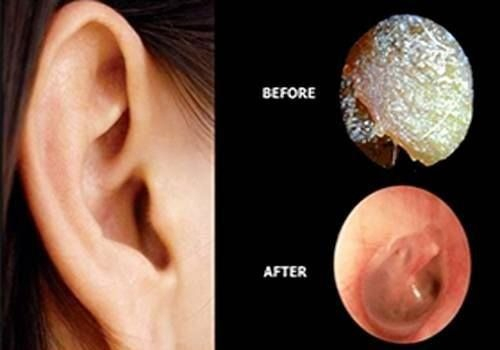 https://www.vista-health.co.uk/media/e3inoxvn/ear-wax-removal.jpg?height=350&rmode=max&width=500